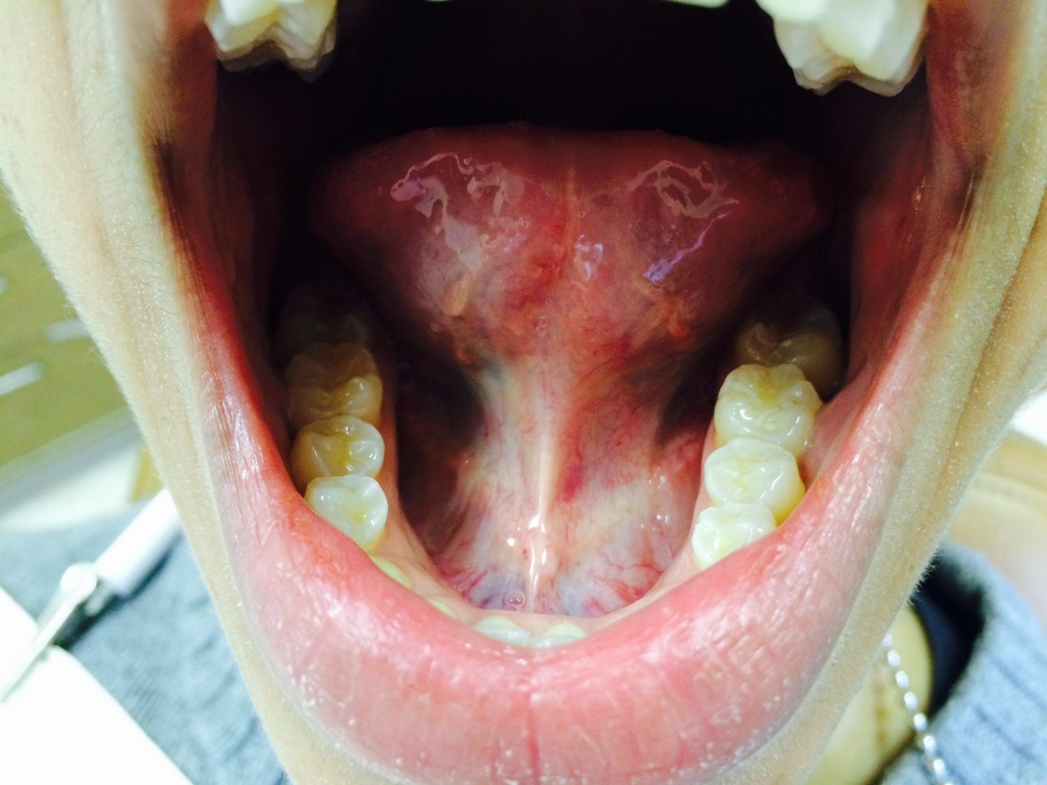 Orofacial Myofunctional Therapy and Frenectomy tongue tie surgery and